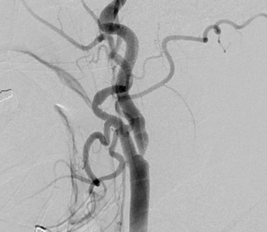 Angiografia da carótida antes do stent, mostrando o estreitamento