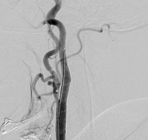 Angiografia de controle depois do implante do stent, com a passagem reaberta