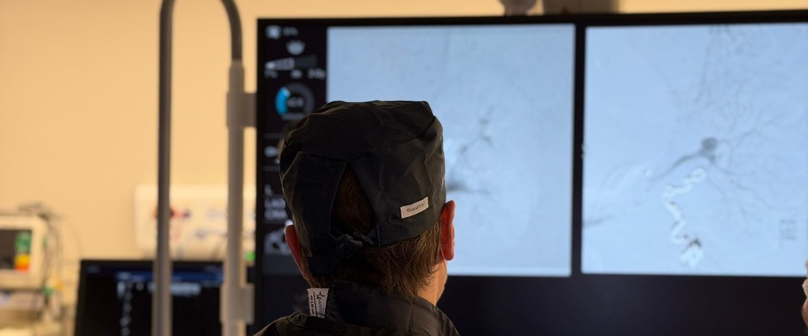 Dois monitores de angiografia mostrando a árvore vascular durante um procedimento endovascular